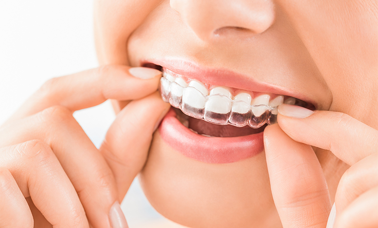Invisalign vs. Braces