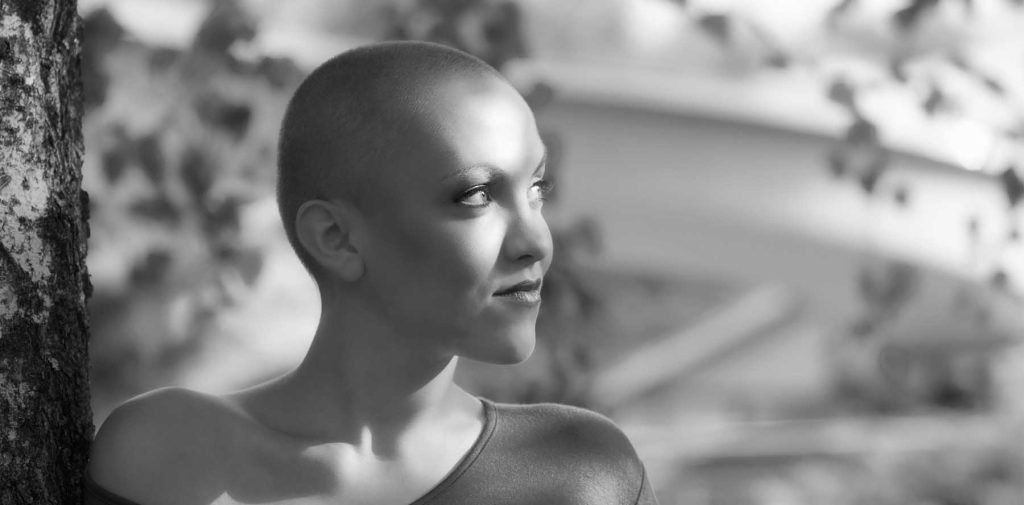 Alopecia Areata