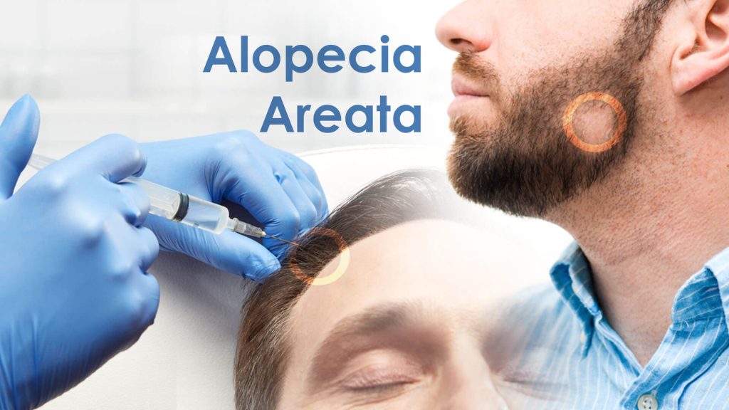 Alopecia Areata