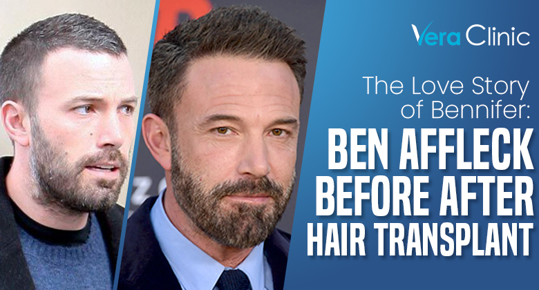 Celebrity Hair Transplant