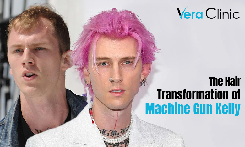 Machine Gun Kelly Hair Transplant