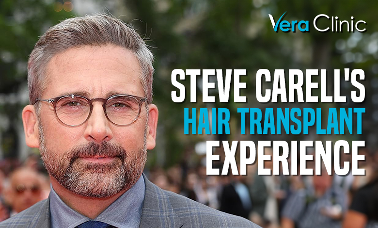 Steve Carell Hair Transplant