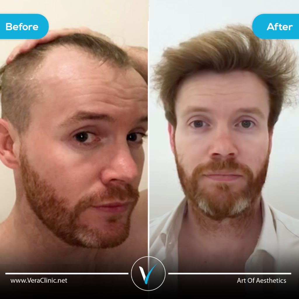 hair transplant before after
