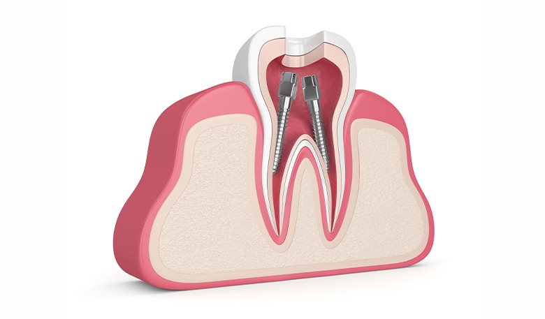 Dental Posts