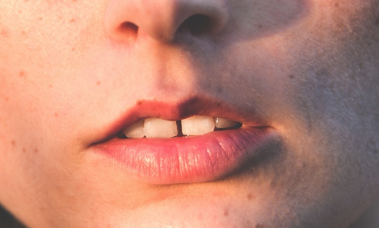 Diastema