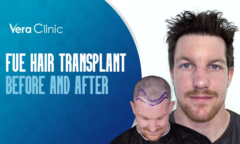 FUEHairTransplantBeforeAndAfter
