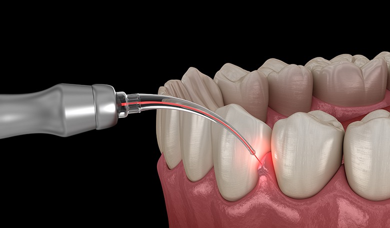 Franectomy