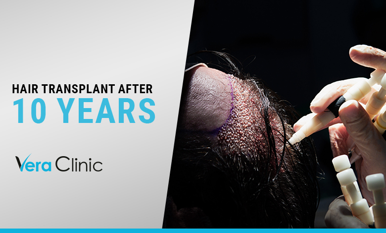 Hair Transplant After 10 Years