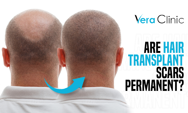 Hair Transplant Scar