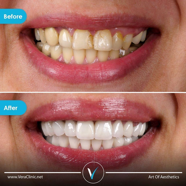 Teeth Whitening