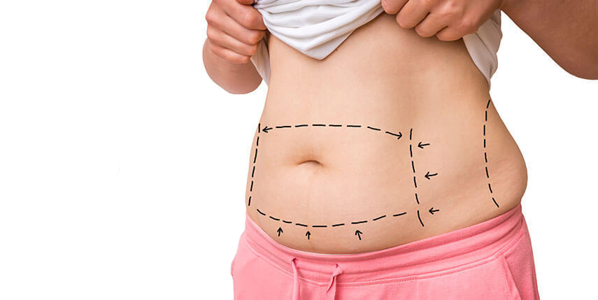precio abdominoplastia