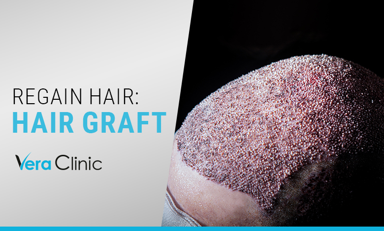 Regain Hair Hair Graft