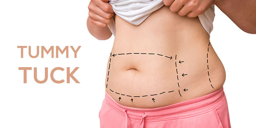 Coût de l'abdominoplastie
