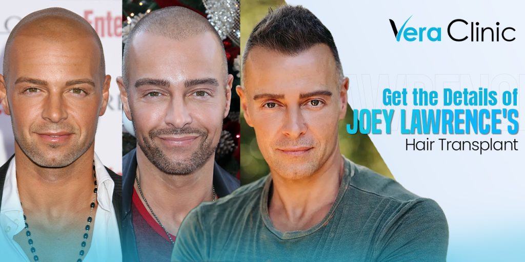 Joey Lawrence Hair Transplant