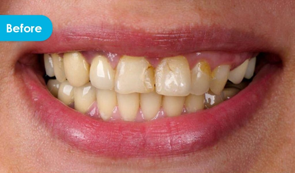 stained teeth before a dental crown