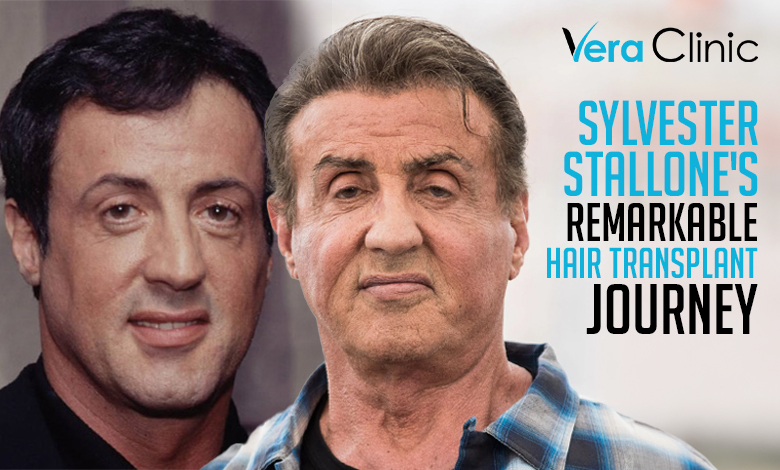 Sylvester Stallone Hair Transplant