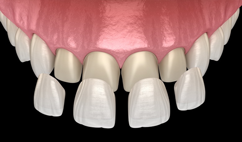 Composite Veneers