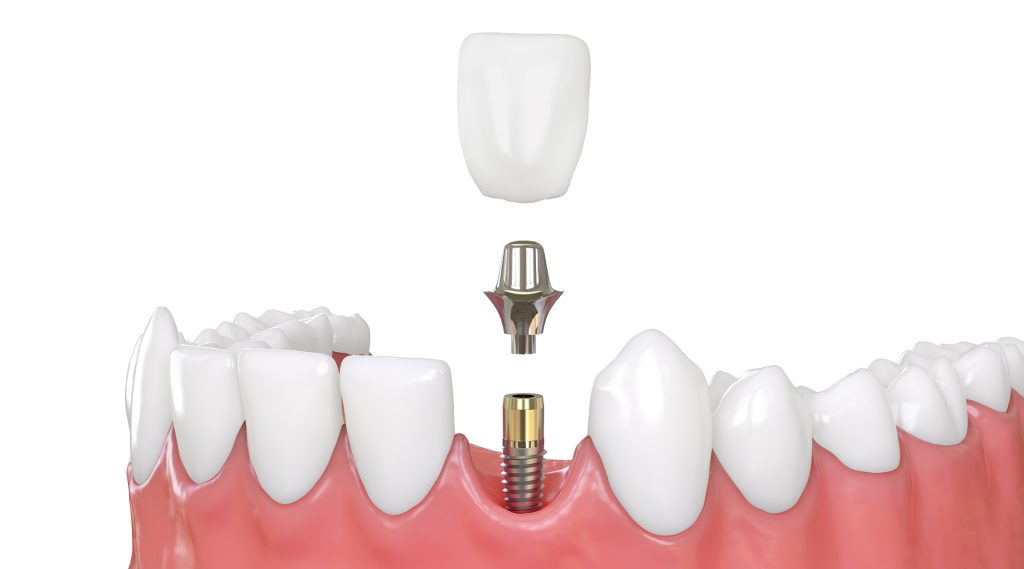 dental implant diagram Replacement Teeth