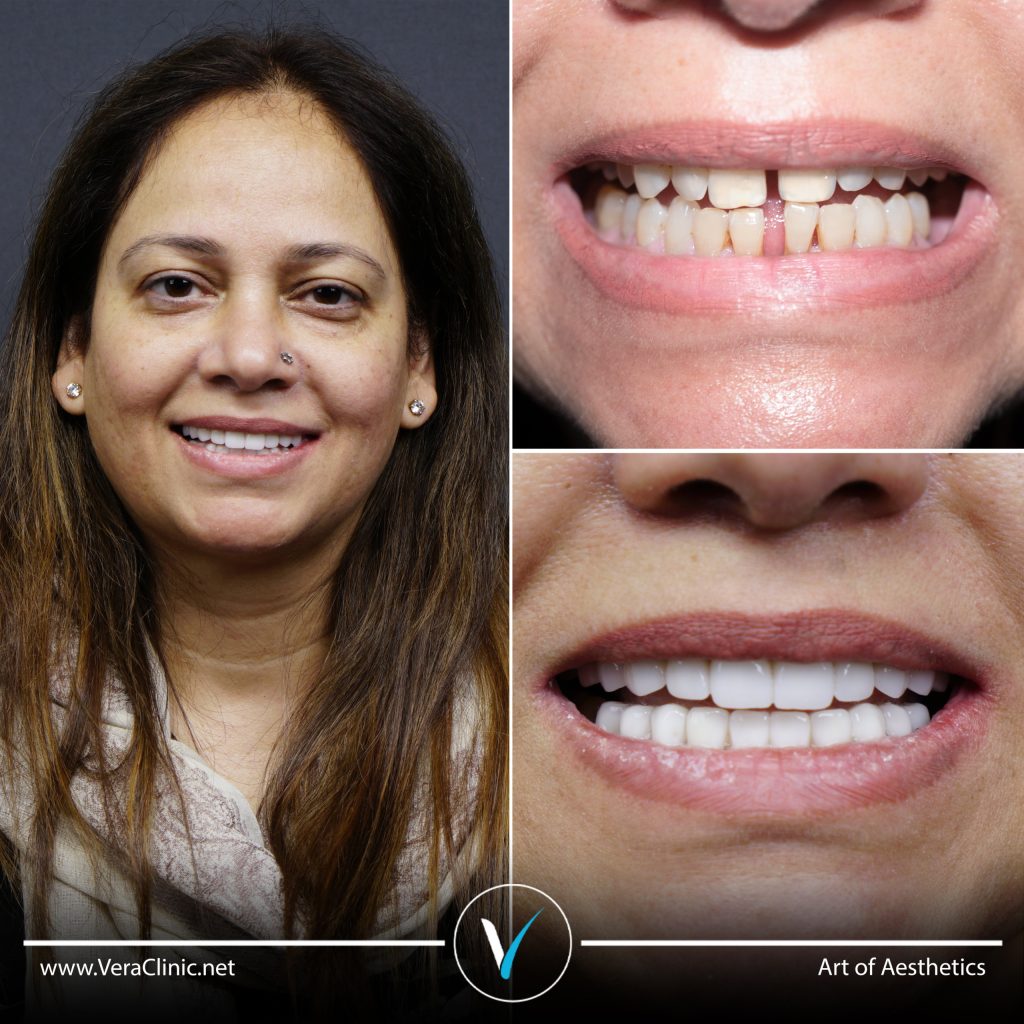 Before and after dentistry - Teeth Gaps