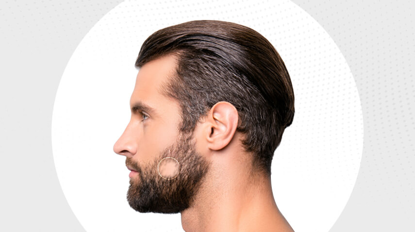 beard transplant in Turkey