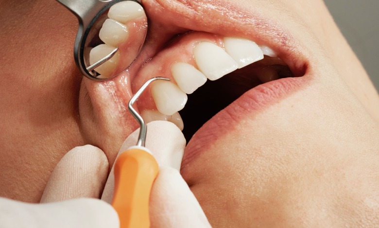 Overbite with Crowns