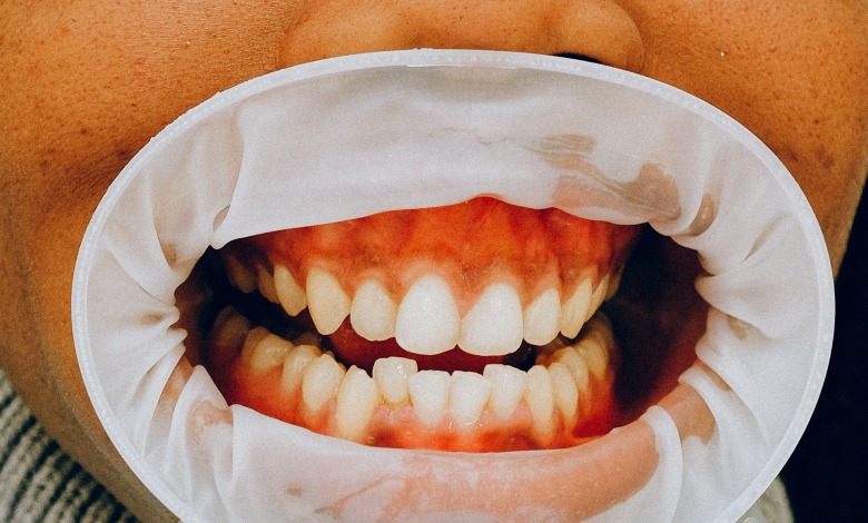 Receding Gums