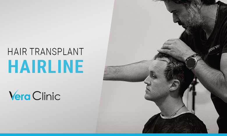 hair transplant hairline