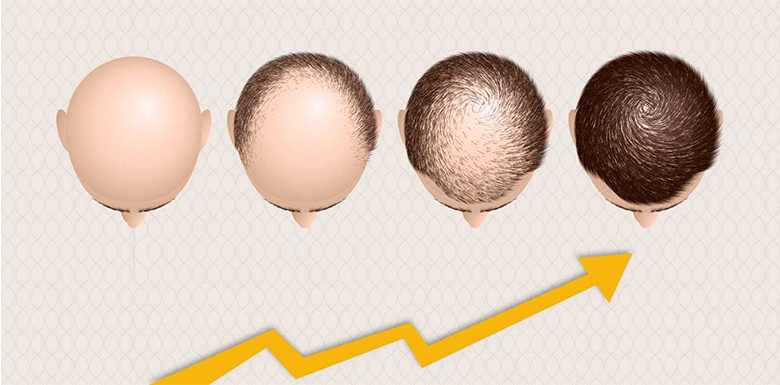 hair transplant timeline