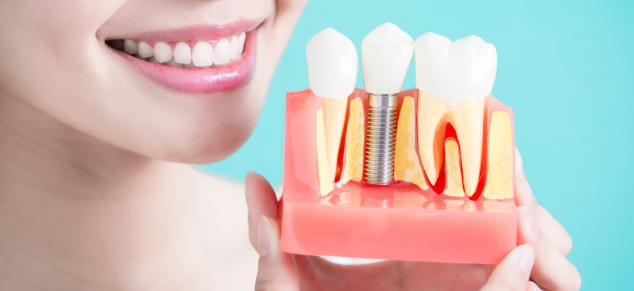 Implantes Dentales