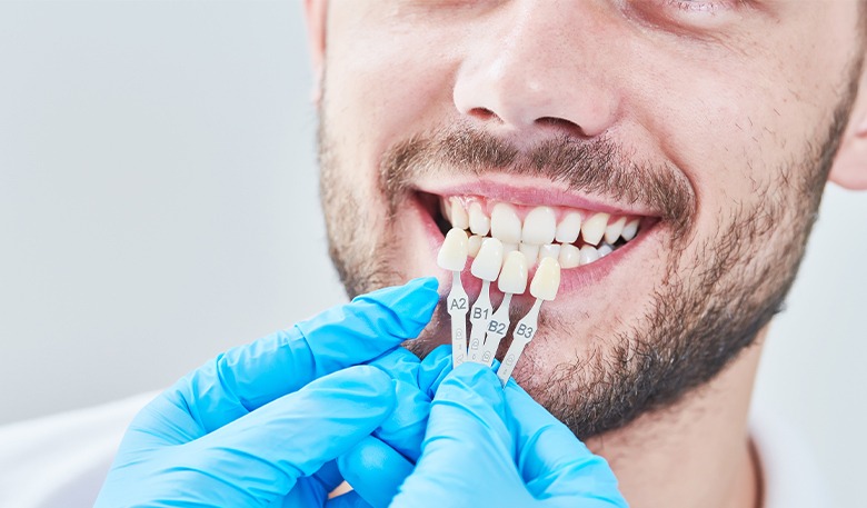 laminate veneers