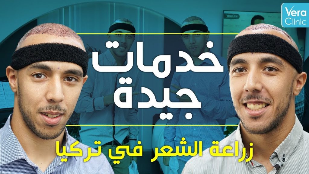hair transplant experience