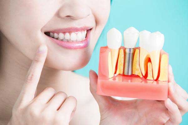 woman holding dental model for crowns