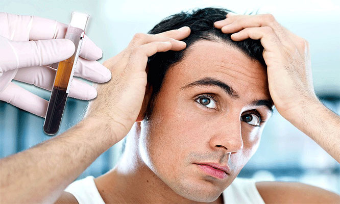 PRP for hair loss