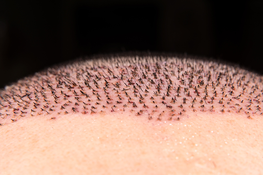 hair transplant scabs