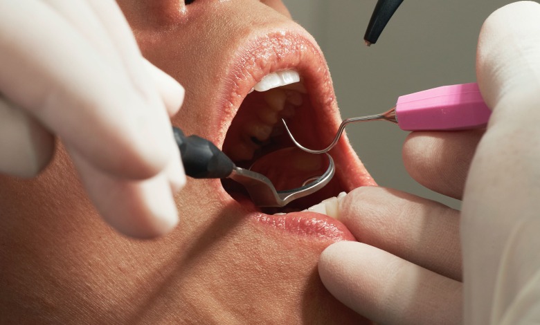 How Long Will My Veneers