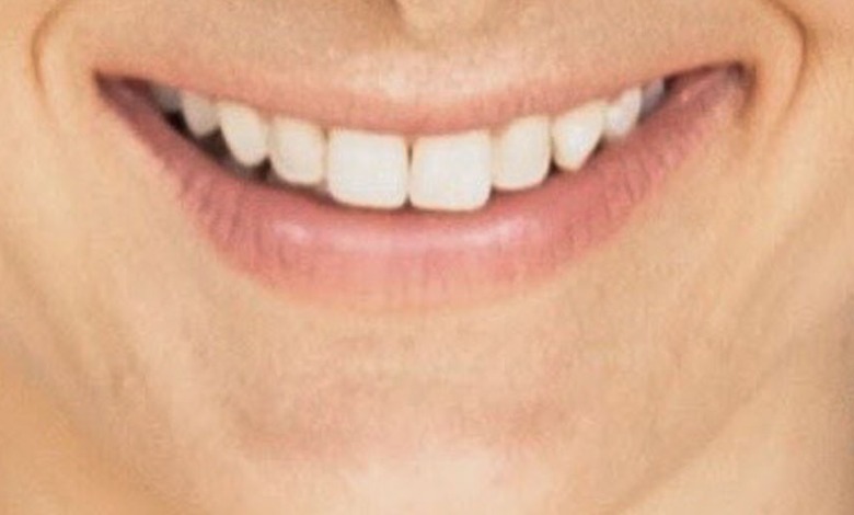 Getting Veneers