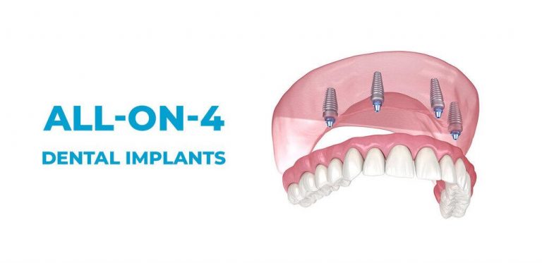 All on 4 implant dentaire