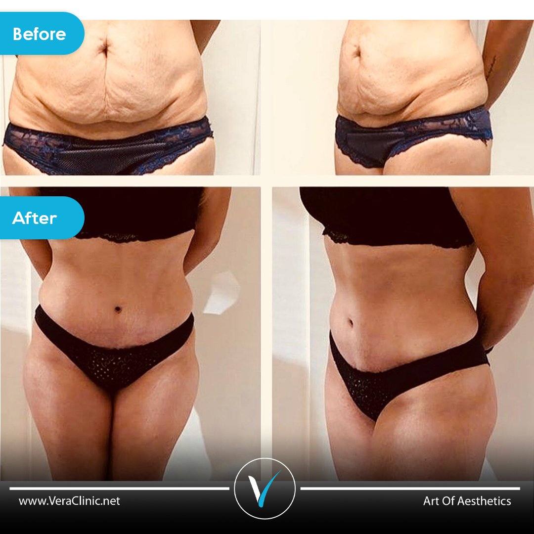 Tummy tuck before and after